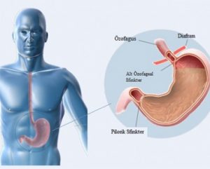Reflü Ne Zaman Kanser Yapar?