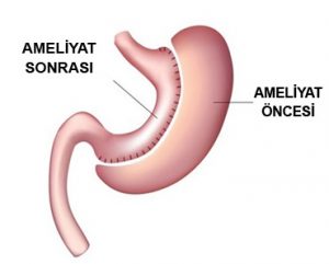 Reflüde Ne Zaman Ameliyat Gerekir?