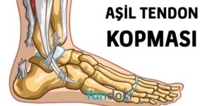 Aşil Ne Demek? Aşil Tendonu Kopması Ne Anlama Gelir Yandoki'de