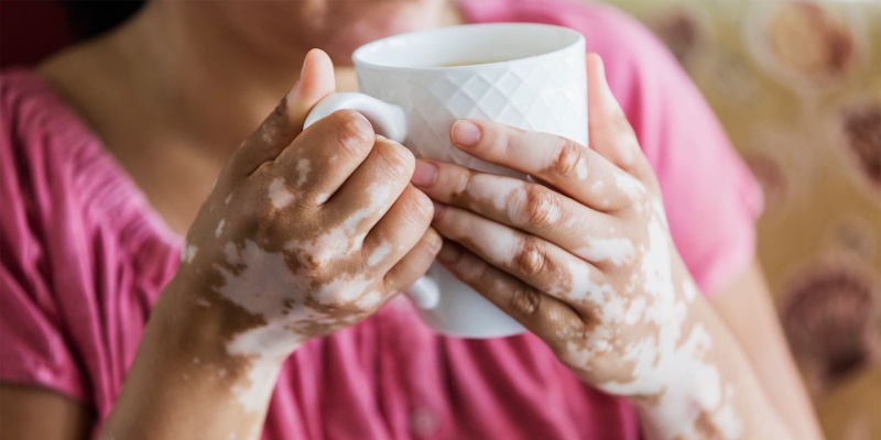 vitiligo olmayan beyaz lekeler